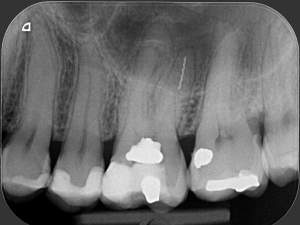 REMOVING A BROKEN TOOL FROM THE UPPER MOLAR